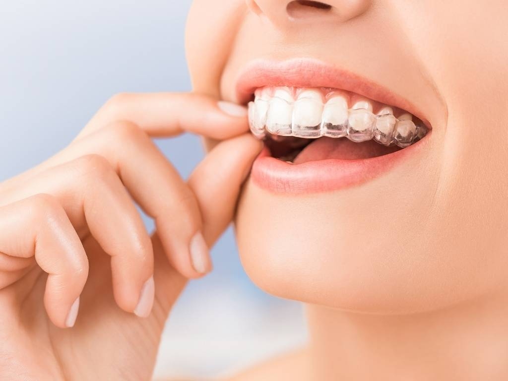 Şeffaf Plaklarla Ortodonti Tedavisi Nedir? - 1